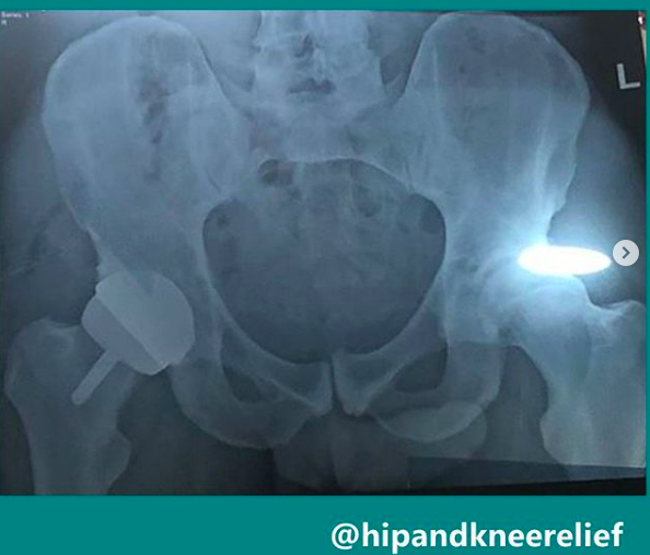Andy Murray hip resurfacing