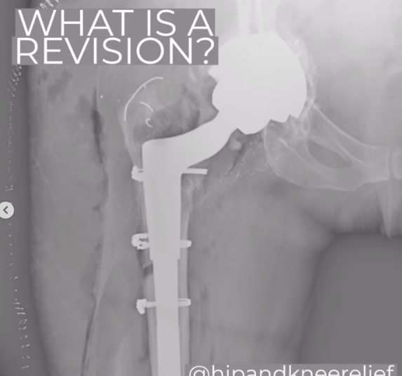 Revision total hip replacement