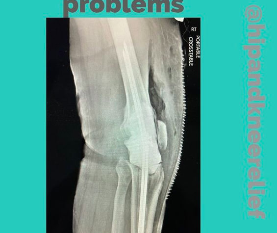 Total knee antibiotic spacer
