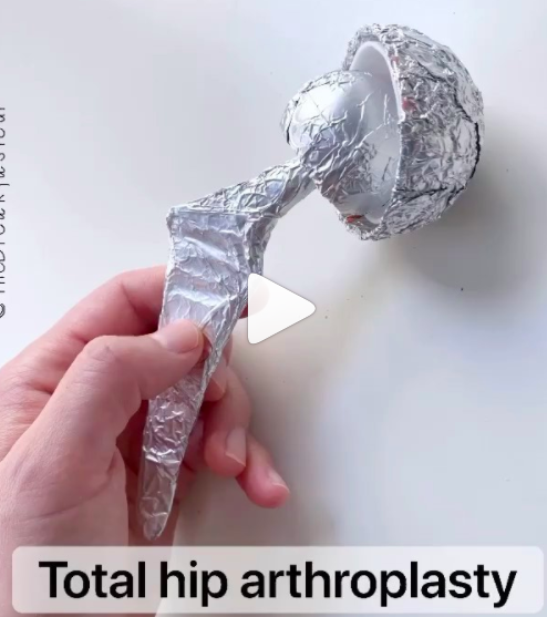 Play Dough Hip Replacement Surgery