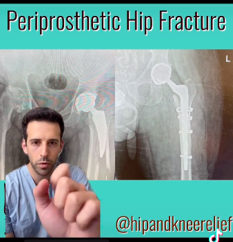 Periprosthetic Femur Fracture Case