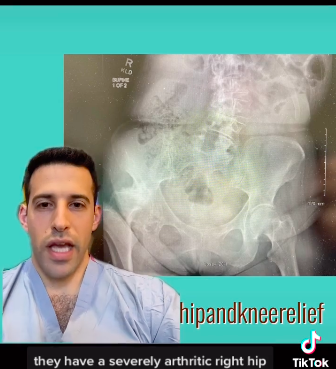 Hip Spine syndrome in hip arthritis